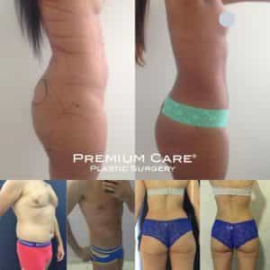 Liposuction in Colombia - Premium Care Liposuction in Colombia - Premium Care Plastic Surgery