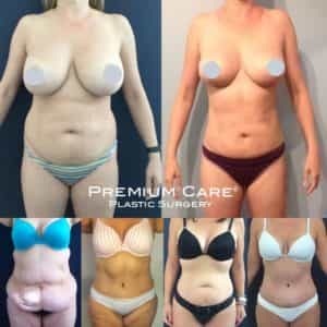 Mommy Makeover in Colombia - Premium Care Plastic Surgery Colombia Mommy Makeover in Colombia at Premium Care Plastic Surgery