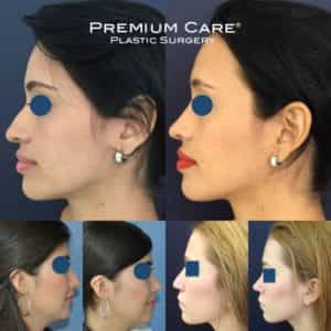 Before and after Rhinoplasty Surgery Colombia - Premium Care Plastic Surgery