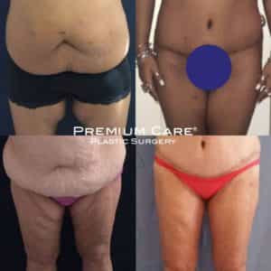 Thigh Lift in Colombia - Premium Care Plastic Surgery