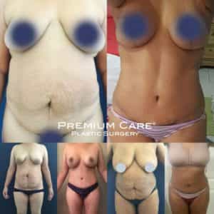 Tummy Tuck in Colombia at Premium Care Plastic Surgery Tummy Tuck in Colombia at Premium Care Plastic Surgery