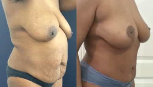 after weight loss colombia 110-2-min