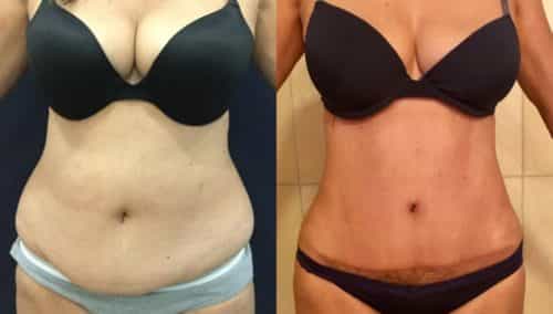 after weight loss colombia 120-1-min