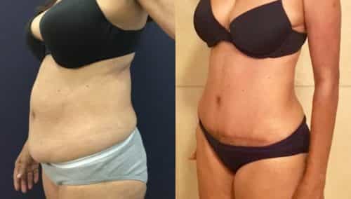 after weight loss colombia 120-2-min