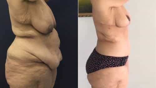 after weight loss colombia 130-2-min