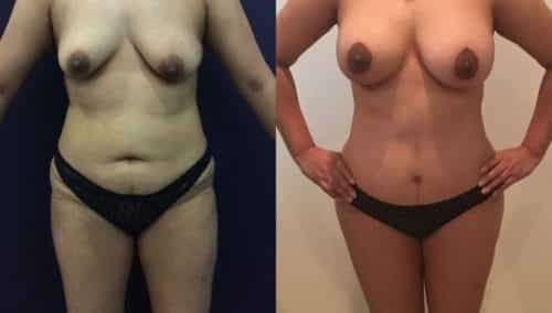 after weight loss colombia 136-1-min