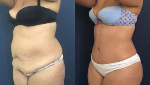 after weight loss colombia 154-2-min