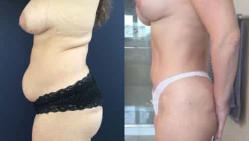 after weight loss colombia 173-3-min