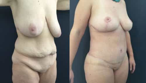 after weight loss colombia 226-4-min
