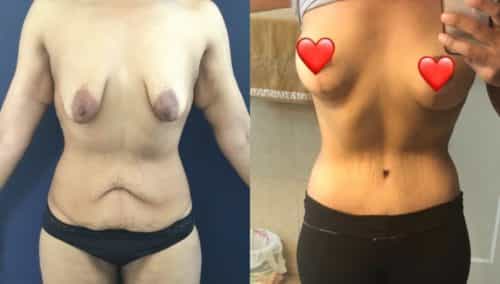 after weight loss colombia 236-1-min