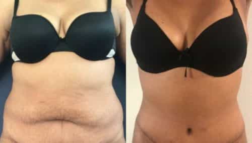 after weight loss colombia 263-1-min