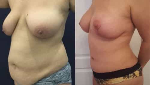 after weight loss colombia 288-2-min