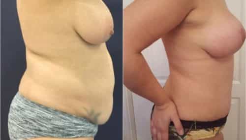 after weight loss colombia 288-5-min