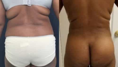 after weight loss colombia 289-3-min