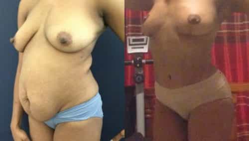 after weight loss colombia 299-2-min