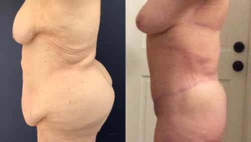 after weight loss colombia 368-2