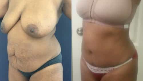 after weight loss colombia 75-2-min