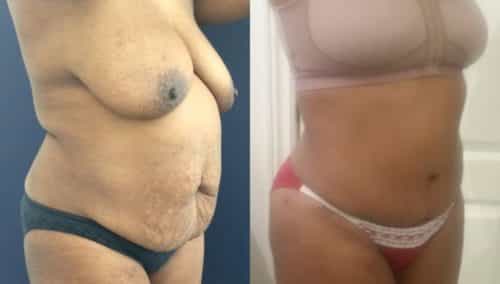 after weight loss colombia 75-4-min