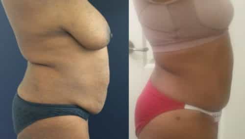 after weight loss colombia 75-5-min