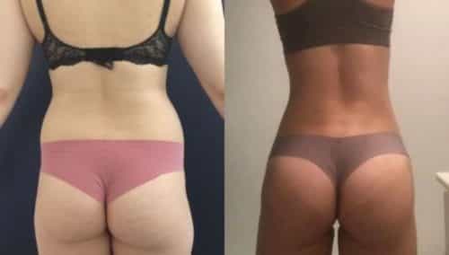 brazilian butt lift colombia 105-1-min