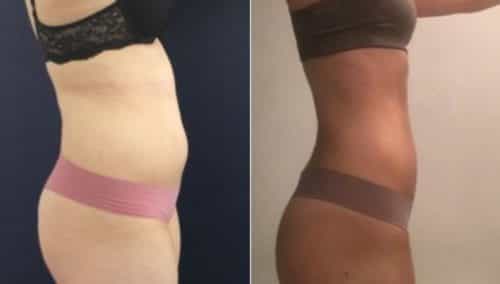 brazilian butt lift colombia 105-2-min