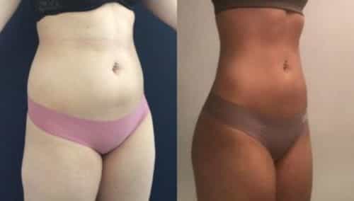 brazilian butt lift colombia 105-3-min
