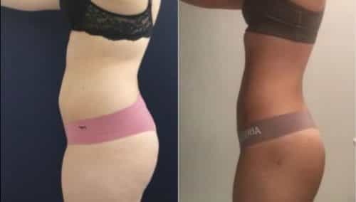 brazilian butt lift colombia 105-4-min