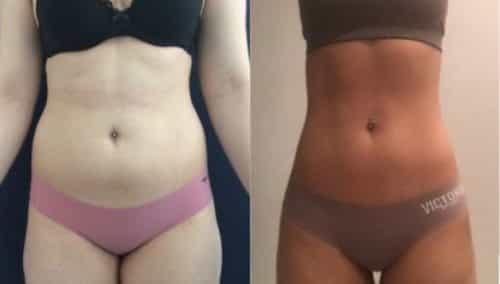 brazilian butt lift colombia 105-6-min