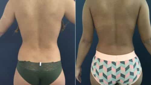 brazilian butt lift colombia 207-1-min