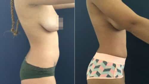 brazilian butt lift colombia 207-2-min