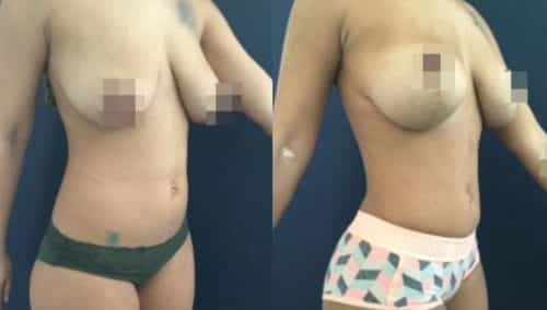 brazilian butt lift colombia 207-3-min