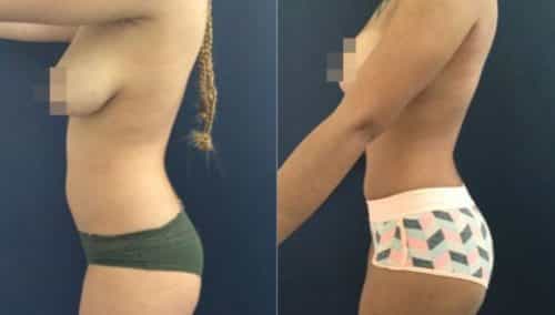 brazilian butt lift colombia 207-4-min