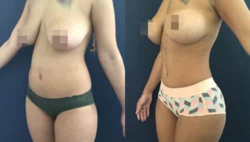 brazilian butt lift colombia 207-5-min
