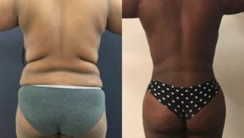brazilian butt lift colombia 209-1-min