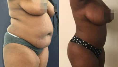 brazilian butt lift colombia 209-2-min