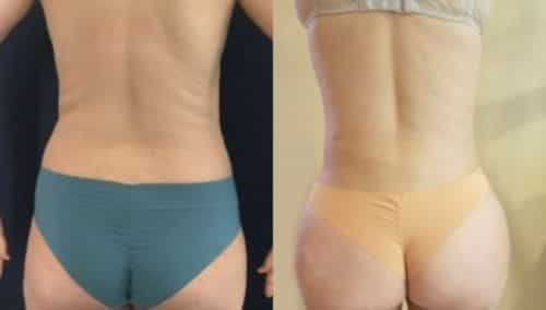 brazilian butt lift colombia 218-1-min