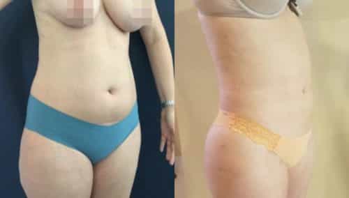 brazilian butt lift colombia 218-3-min