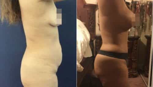 brazilian butt lift colombia 219-2-min