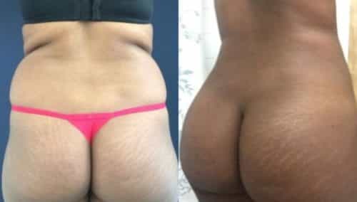 brazilian butt lift colombia 225-1-min