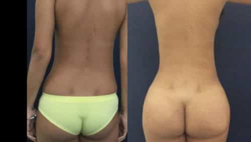 brazilian butt lift colombia 231-1-min
