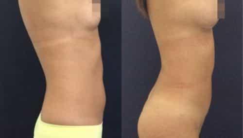 brazilian butt lift colombia 231-2-min