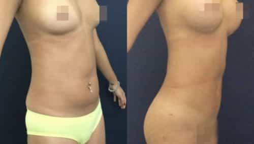 brazilian butt lift colombia 231-3-min