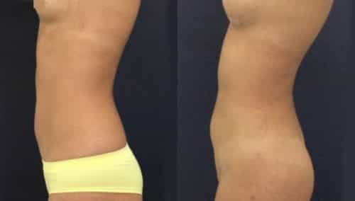 brazilian butt lift colombia 231-4-min