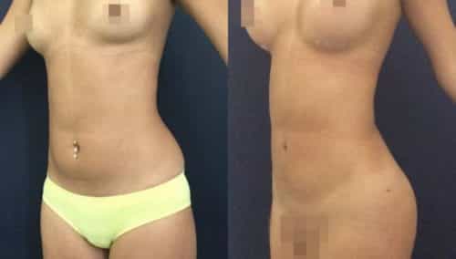 brazilian butt lift colombia 231-5-min