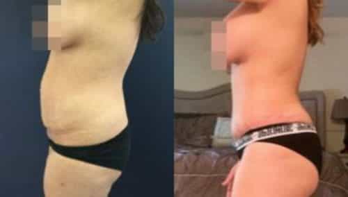 brazilian butt lift colombia 235-3-min