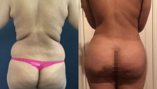 brazilian butt lift colombia 238-1-min