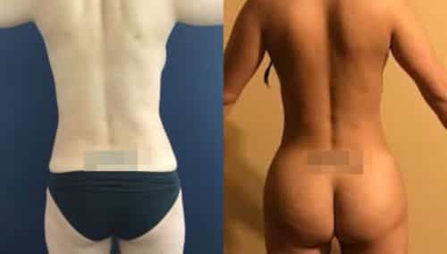 brazilian butt lift colombia 242-1-min