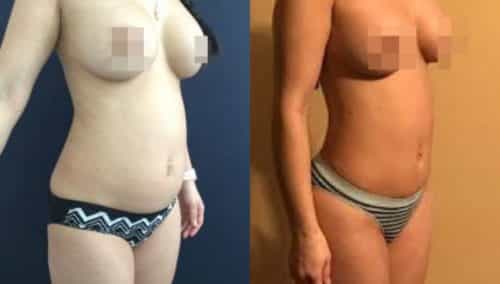 brazilian butt lift colombia 242-3-min