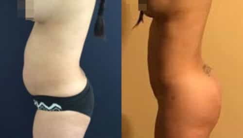 brazilian butt lift colombia 242-4-min