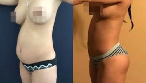 brazilian butt lift colombia 242-5-min